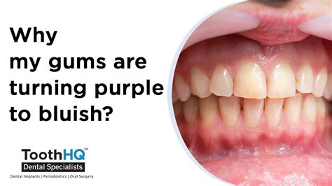 purple colored gums