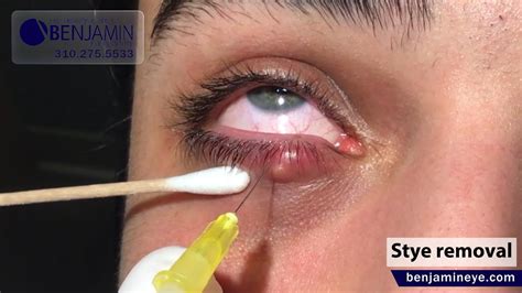 pus in eyelid treatment
