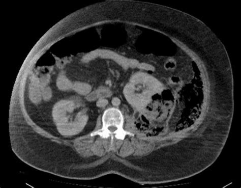 pyelonefrit man viss