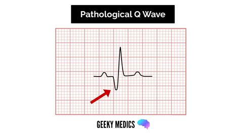 Q Waves Ecg