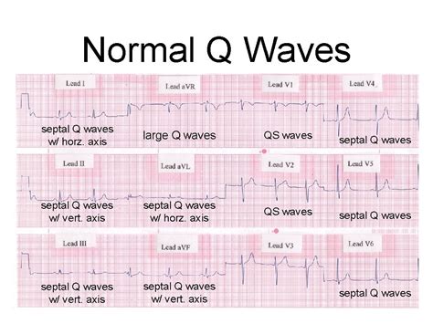 Q Waves On Ekg