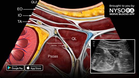 Quadratus Lumborum Block