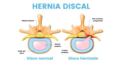 Que Es Una Herniacion