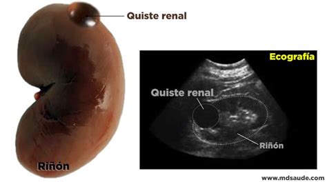 Quiste Cortical Renal