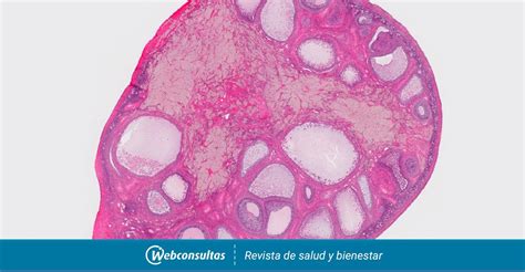 quiste follicular de ovario histologia pdf