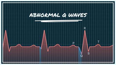 Qwave On Ecg