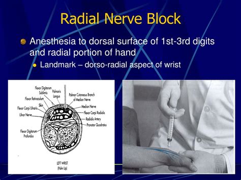 Radial Nerve Decompression Cpt Code