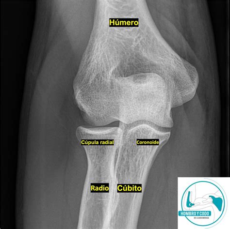 Radiografia De Codo