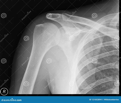 Radiografia Hombro Normal