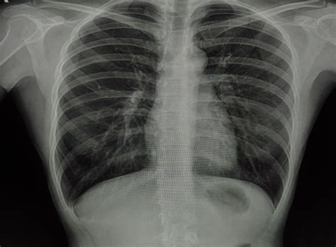 Radiografia Torax Normal