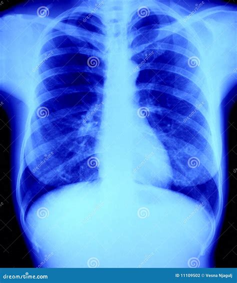 Raio X Pulmão Normal X Pneumonia