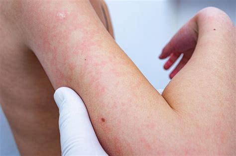 rash