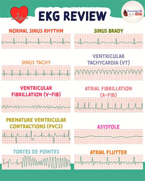 Reading Ekg Cheat Sheet