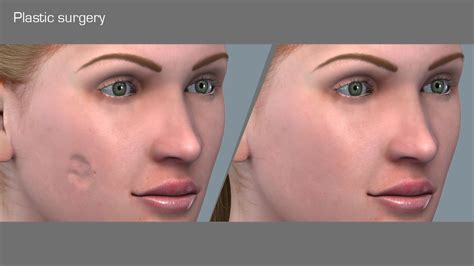 Reconstructive Plastic Surgery Of The Head And Neck Current Techniques And Flap Atlas