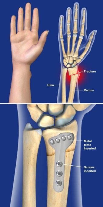 Recovering From A Distal Radius Fracture - Operatoto.com