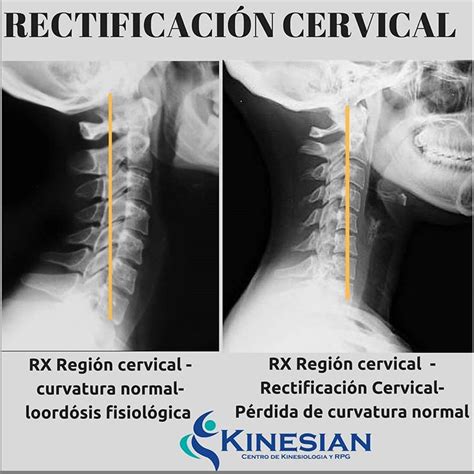 Rectificación De Cabeza