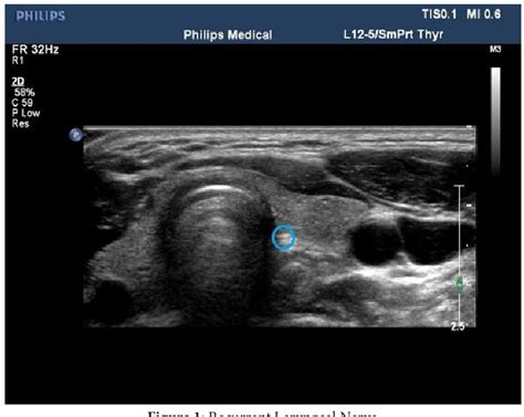 recurrent laryngeal nerve ultrasound