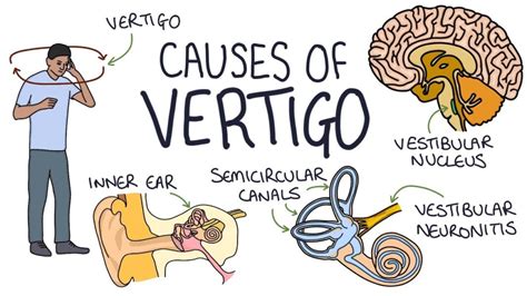 Download Recurring Vertigo Manual Guide 