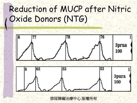 Reduction In Mucp