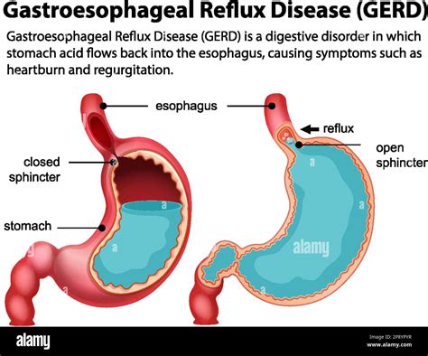 reflux