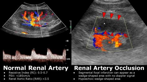Renal Doppler Test