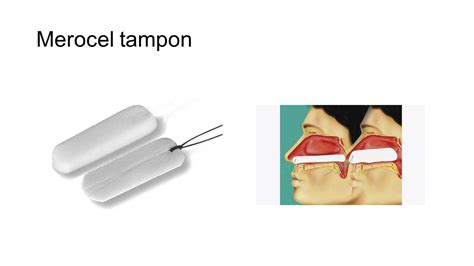 retained tampon - UpToDate