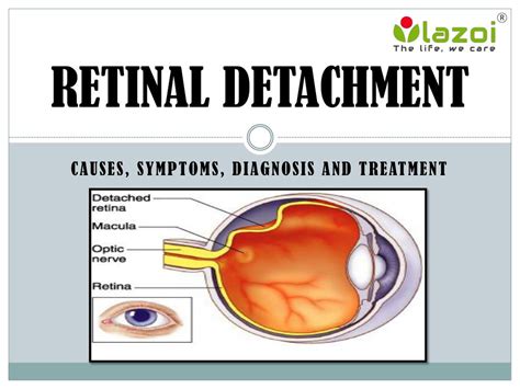 Retinal Detachment Ppt