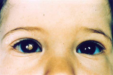 retinoblastoma - dessensibilizante dental