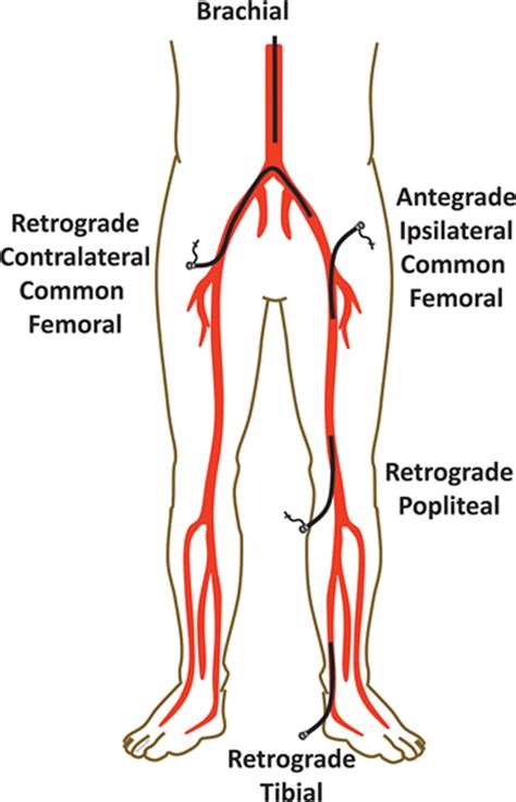 retrograde benadering