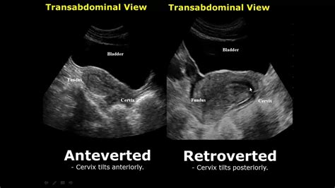 retroverted uterus ultrasound dating