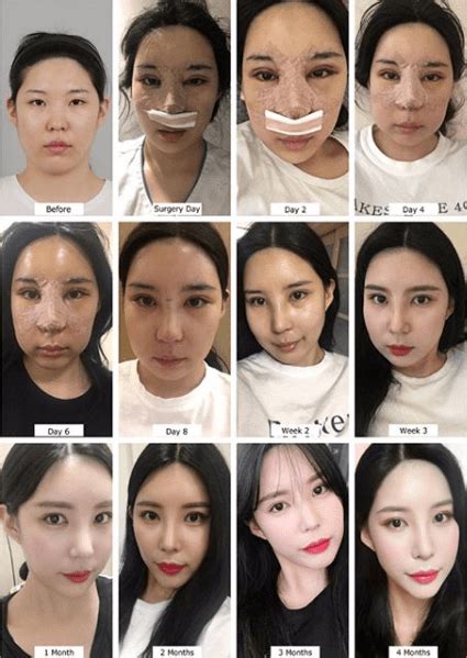 rhinoplasty healing time