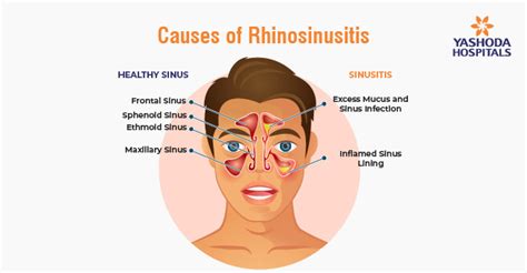 Rhinosinusitis Icd 10