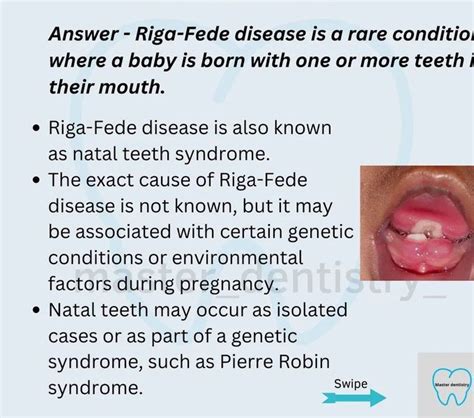 Riga Fede Disease