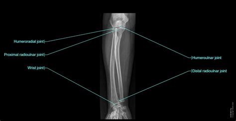 Right Arm Radiograph