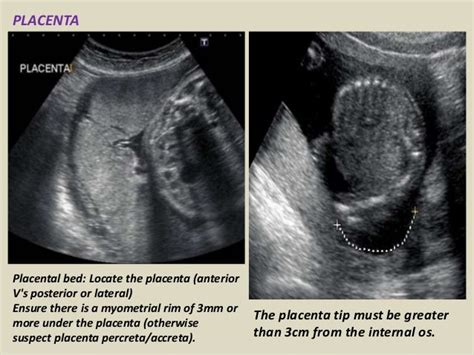 right lateral placenta gender ultrasound