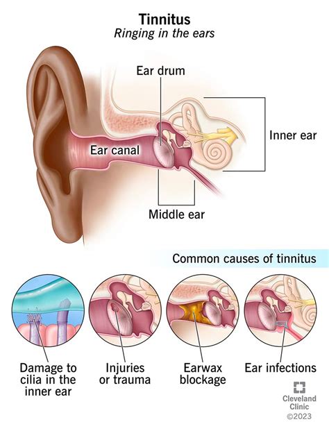 ringing in ear gets louder when yawning