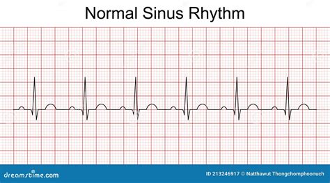 Ritmo Sinusal Normal