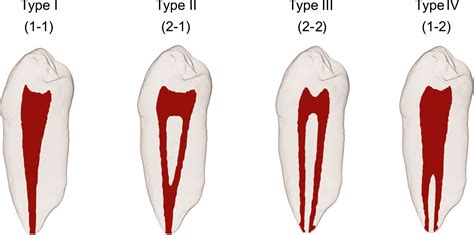 Read Root Canal Morphology And Its Relationship To Endodontic 