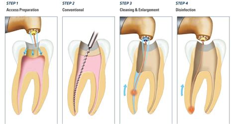 Download Root Canal Preparation With Two Different Rotary Systems 