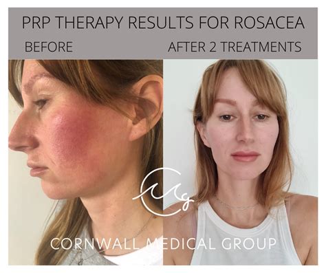 rosacea ekşi