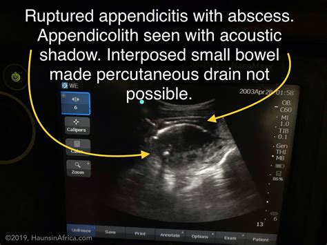 Ruptured Appendix Abscess