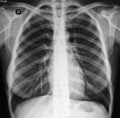 Rx De Torax Normal