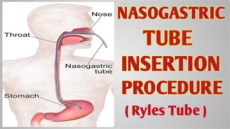 Ryles Tube Insertion
