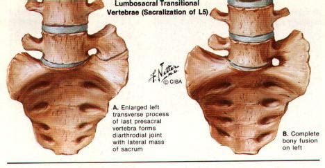 Sacralisation Of L5