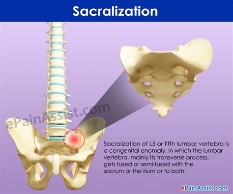 Sacralization Of L5 Vertebra
