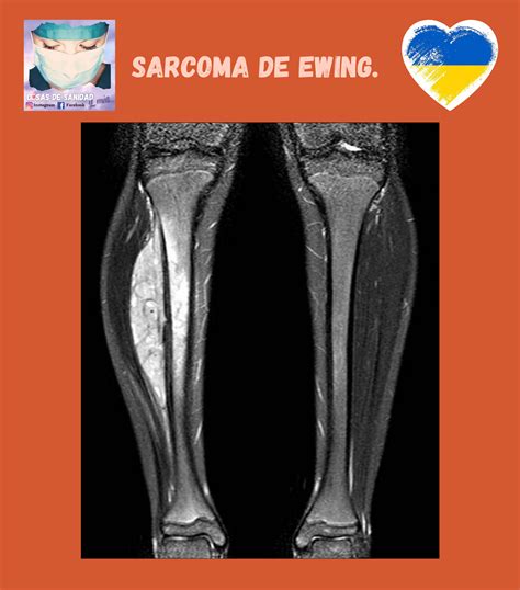 Sarcoma De Ewing Sintomas