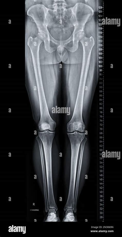 Scanogram X Ray