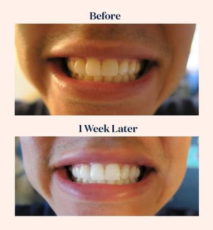 Science Of Teeth Whitening Ndash Laughland Sciences Inc Science Of Teeth - Science Of Teeth
