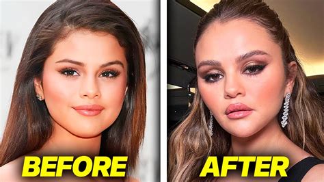 Selena Gomez Plastic Surgery Reddit