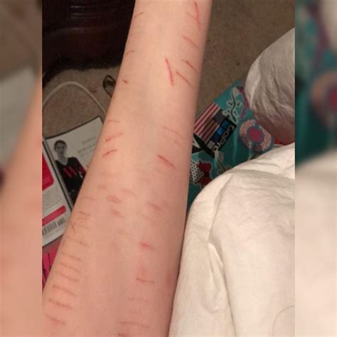 self harm | Selfharm Li ku cu trong bng ti